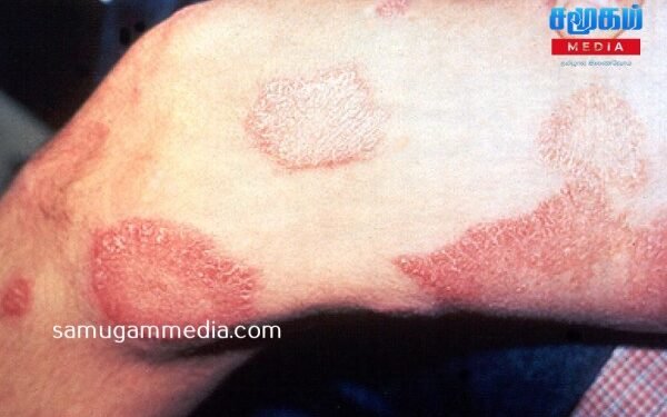 தொழு நோயாளர்களை கட்டுப்படுத்த விழிப்புணர்வு